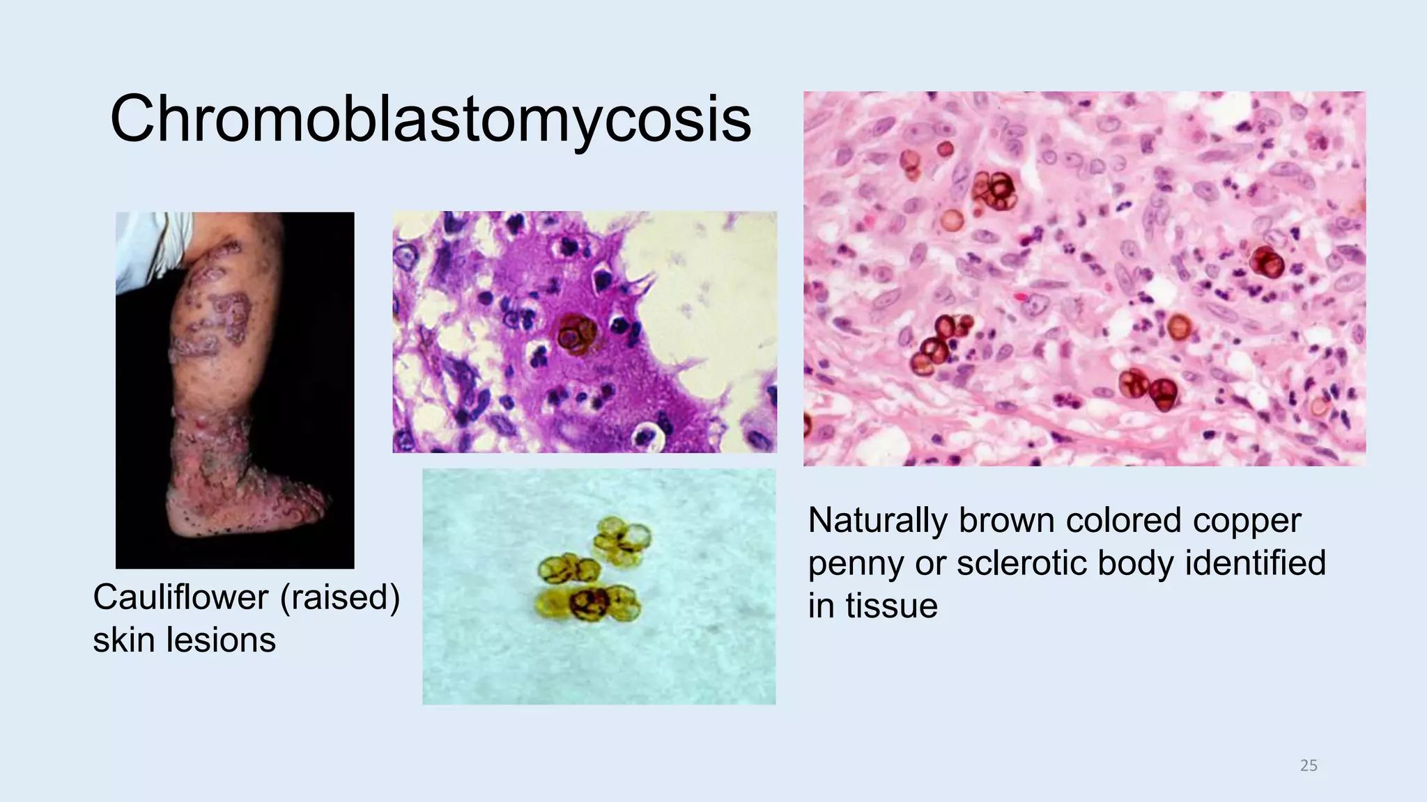 Bumpy Cauliflower Rash Fungal Pathology in Tissue | PPTX