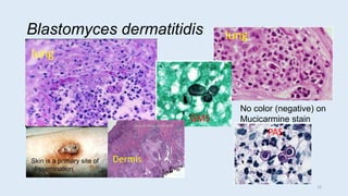 Blastomyces dermatitidis
No color (negative) on
Mucicarmine stain
stain S
lung
lung
Skin is a primary site of
dissemination
GMS
PAS
Dermis
15
 