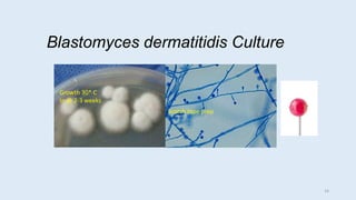 Blastomyces dermatitidis Culture
Scotch tape prep
Growth 30* C
In @ 2-3 weeks
16
 