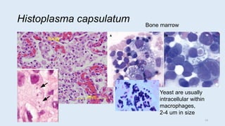 Histoplasma capsulatum Bone marrow
lung
Yeast are usually
intracellular within
macrophages,
2-4 um in size
19
 
