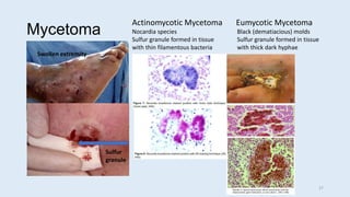 Mycetoma
Sulfur
granule
Actinomycotic Mycetoma Eumycotic Mycetoma
Nocardia species Black (dematiacious) molds
Sulfur granule formed in tissue Sulfur granule formed in tissue
with thin filamentous bacteria with thick dark hyphae
Swollen extremity
27
 