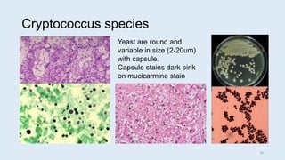 Cryptococcus species
Yeast are round and
variable in size (2-20um)
with capsule.
Capsule stains dark pink
on mucicarmine stain
29
 