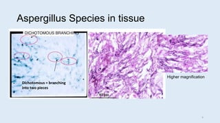 Aspergillus Species in tissue
Dichotomous = branching
into two pieces
Higher magnification
4
 