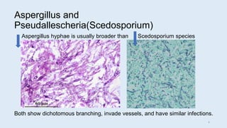 Aspergillus and
Pseudallescheria(Scedosporium)
Aspergillus hyphae is usually broader than Scedosporium species
Both show dichotomous branching, invade vessels, and have similar infections.
6
 