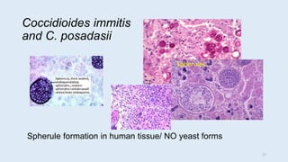 Coccidioides immitis
and C. posadasii
Spherule formation in human tissue/ NO yeast forms
Spherules
17
 