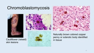 Chromoblastomycosis
Cauliflower (raised)
skin lesions
Naturally brown colored copper
penny or sclerotic body identified
in...
