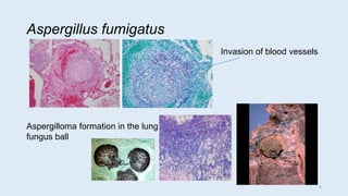 Aspergillus fumigatus
Aspergilloma formation in the lung
fungus ball
Invasion of blood vessels
8
 