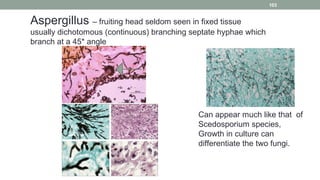 Aspergillus – fruiting head seldom seen in fixed tissue
usually dichotomous (continuous) branching septate hyphae which
branch at a 45* angle
Can appear much like that of
Scedosporium species,
Growth in culture can
differentiate the two fungi.
103
 
