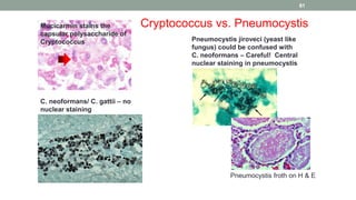Mucicarmin stains the
capsular polysaccharide of
Cryptococcus Pneumocystis jiroveci (yeast like
fungus) could be confused with
C. neoformans – Careful! Central
nuclear staining in pneumocystis
C. neoformans/ C. gattii – no
nuclear staining
Cryptococcus vs. Pneumocystis
Pneumocystis froth on H & E
81
 