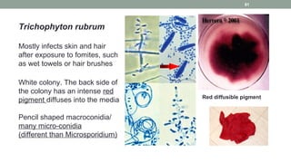 Trichophyton rubrum
Mostly infects skin and hair
after exposure to fomites, such
as wet towels or hair brushes
White colony. The back side of
the colony has an intense red
pigment diffuses into the media
Pencil shaped macroconidia/
many micro-conidia
(different than Microsporidium)
Red diffusible pigment
91
 