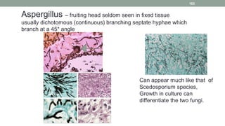 Aspergillus – fruiting head seldom seen in fixed tissue
usually dichotomous (continuous) branching septate hyphae which
br...