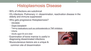 Histoplasmosis Disease
• 95% of infections are subclinical
• 5% infections: Pulmonary +/- dissemination, reactivation dise...