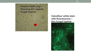 Positive KOH prep
Showing thin septate
fungal hyphae
Calcofluor white stain
with fluorescence –
thin fungal hyphae
88
 