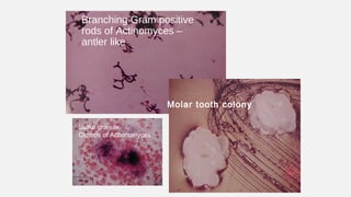 Branching Gram positive
rods of Actinomyces –
antler like
Molar tooth colony
Sulfur granule
Clumps of Actionomyces
 