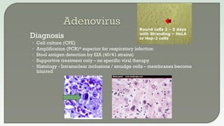  Diagnosis
• Cell culture (CPE)
• Amplification (PCR)* superior for respiratory infection
• Stool antigen detection by EIA (40/41 strains)
• Supportive treatment only – no specific viral therapy
• Histology - Intranuclear inclusions / smudge cells – membranes become
blurred
Round cells 2 – 5 days
with Stranding – HeLA
or Hep-2 cells
 