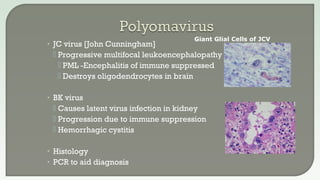• JC virus [John Cunningham]
 Progressive multifocal leukoencephalopathy -
 PML -Encephalitis of immune suppressed
 Destroys oligodendrocytes in brain
• BK virus
 Causes latent virus infection in kidney
 Progression due to immune suppression
 Hemorrhagic cystitis
• Histology
• PCR to aid diagnosis
Giant Glial Cells of JCV
 
