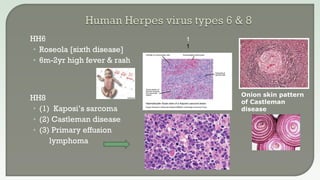  HH6
• Roseola [sixth disease]
• 6m-2yr high fever & rash
 HH8
• (1) Kaposi’s sarcoma
• (2) Castleman disease
• (3) Primary effusion
lymphoma
Onion skin pattern
of Castleman
disease
1
1
 