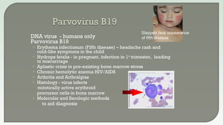  DNA virus - humans only
 Parvovirus B19
• Erythema infectiosum (Fifth disease) – headache rash and
cold-like symptoms in the child
• Hydrops fetalis - in pregnant, infection in 1st
trimester, leading
to miscarriage
• Aplastic crisis in pre-existing bone marrow stress
• Chronic hemolytic anemia HIV/AIDS
• Arthritis and Arthralgias
• Histology - virus infects
mitotically active erythroid
precursor cells in bone marrow
• Molecular and Serologic methods
to aid diagnosis
Slapped face appearance
of fifth disease
 