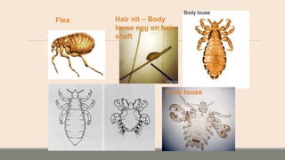 Flea
Body louse
Crab louse
Hair nit – Body
louse egg on hair
shaft
 