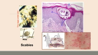 Scabies
Tinyeggsunderskin
Mite
 
