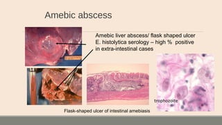 Amebic abscess
Flask-shaped ulcer of intestinal amebiasis
Amebic liver abscess/ flask shaped ulcer
E. histolytica serology – high % positive
in extra-intestinal cases
trophozoite
 