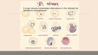 P.vivax induces morphologic alterrations in the infected rbc
Schuffners dots/granules
 