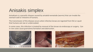 Anisakis simplex
Anisakiasis is a parasitic disease caused by anisakid nematode (worms) that can invade the
stomach wall or intestine of humans.
The transmission of this disease occurs when infective larvae are ingested from fish or squid
that humans eat raw or undercooked.
In some cases, this infection is treated by removal of the larvae via endoscopy or surgery. Can
in rare cases cause granuloma formation and obstruction.
 