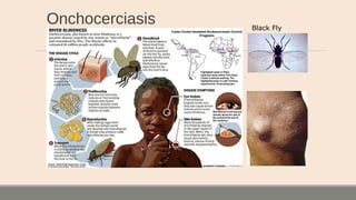 Onchocerciasis Black Fly
 