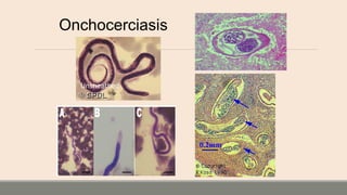 Onchocerciasis
Unsheathed
 
