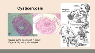Cysticercosis
Caused by the ingestion of T. solium
Eggs / Not by eating infected pork
 