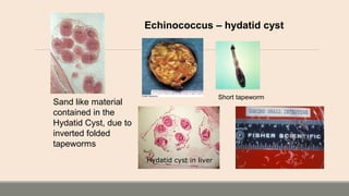 Echinococcus – hydatid cyst
Short tapeworm
Sand like material
contained in the
Hydatid Cyst, due to
inverted folded
tapeworms
Hydatid cyst in liver
 