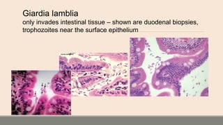 Giardia lamblia
only invades intestinal tissue – shown are duodenal biopsies,
trophozoites near the surface epithelium
 