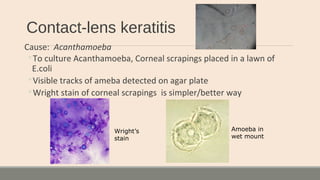 Contact-lens keratitis
Cause: Acanthamoeba
◦To culture Acanthamoeba, Corneal scrapings placed in a lawn of
E.coli
◦Visible tracks of ameba detected on agar plate
◦Wright stain of corneal scrapings is simpler/better way
Wright’s
stain
Amoeba in
wet mount
 