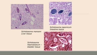 Schistosoma mansoni
Liver tissue
Schistosoma japonicum
Intestine tissue
Schistosoma
Haematobium –
bladder tissue
 