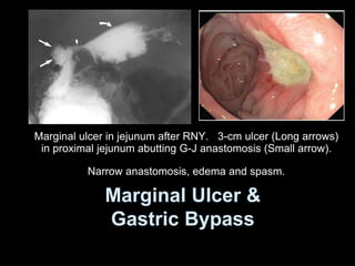 Marginal Ulcer &
Gastric Bypass
Marginal ulcer in jejunum after RNY. 3-cm ulcer (Long arrows)
in proximal jejunum abutting G-J anastomosis (Small arrow).
Narrow anastomosis, edema and spasm.
 