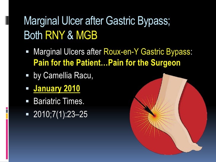 Marginal ulcer gastric bypass