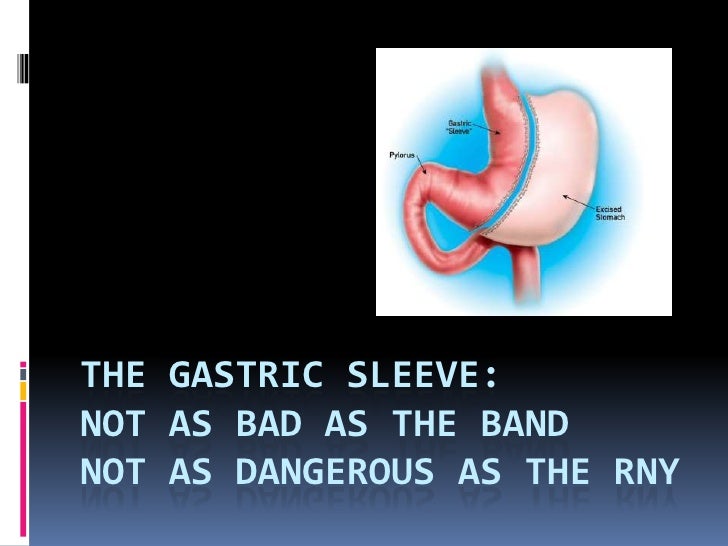 Marginal ulcer gastric bypass