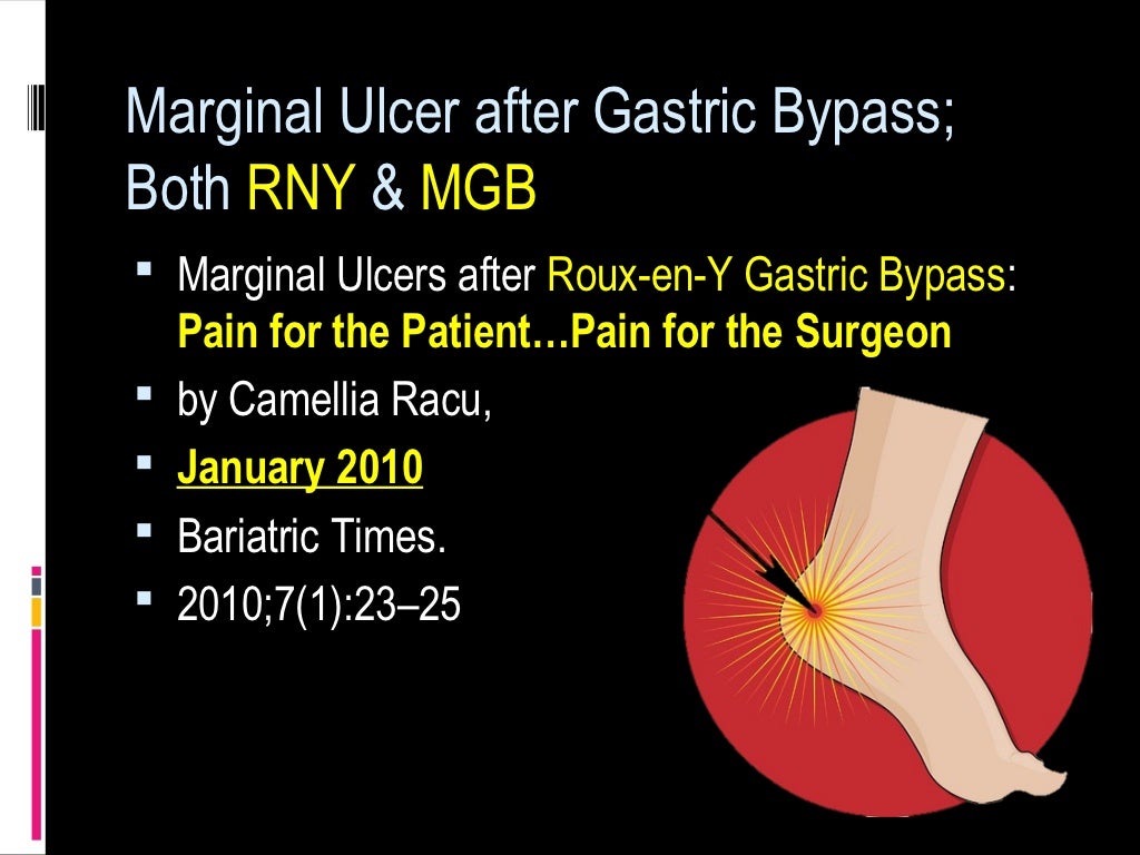 Marginal ulcer gastric bypass