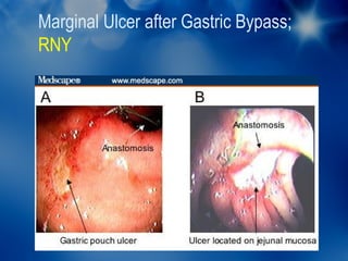 Marginal Ulcer after Gastric Bypass;
RNY
 