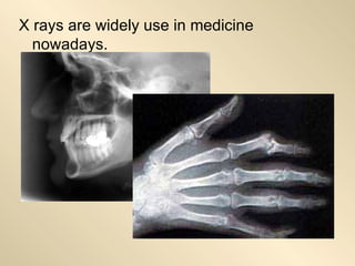 X rays are widely use in medicine nowadays. 