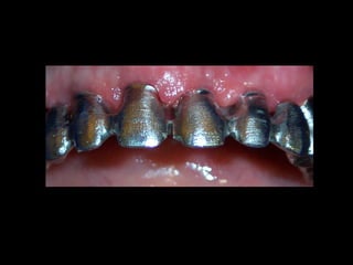 Rehabilitación oral sobre implantes