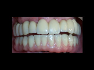 Rehabilitación oral sobre implantes
