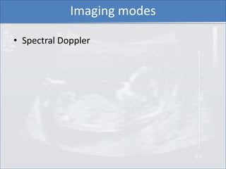 Imaging modes

• Spectral Doppler
 