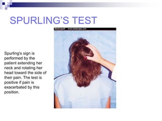 SPURLING’S TEST
Spurling's sign is
performed by the
patient extending her
neck and rotating her
head toward the side of
their pain. The test is
positive if pain is
exacerbated by this
position.
 