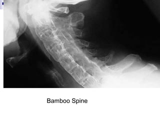 Bamboo Spine
 