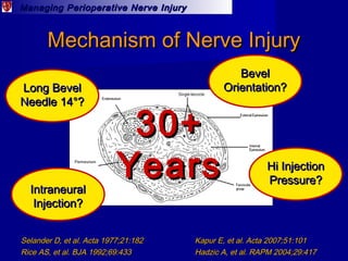 Managing Perioperative Nerve InjuryManaging Perioperative Nerve Injury
Mechanism of Nerve InjuryMechanism of Nerve Injury
...