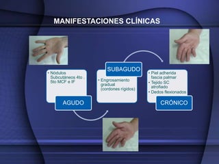 MANIFESTACIONES CLÍNICAS




                          SUBAGUDO
• Nódulos                                    • Piel adherida
  Subcutáneos 4to .                            fascia palmar
                      • Engrosamiento
  5to MCF e IF
                        gradual              • Tejido SC
                        (cordones rígidos)     atrofiado
                                             • Dedos flexionados

       AGUDO                                       CRÓNICO
 