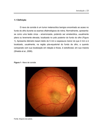 Introdução | 23
1.1 Definição
O nevo de coroide é um tumor melanocítico benigno encontrado ao acaso no
fundo do olho durante os exames oftalmológicos de rotina. Normalmente, apresenta-
se como uma lesão cinza - amarronzada, podendo ser amelanótica, usualmente
plana ou levemente elevada, localizada no polo posterior do fundo do olho (Figura
1). Apresenta diâmetro basal médio de 5 mm e espessura menor do que 2 mm e é
localizado, usualmente, na região pós-equatorial do fundo de olho, e quando
comparado com sua localização em relação à fóvea, é extrafoveal, em sua maioria
(Shields et al., 2008).
Figura 1 - Nevo de coroide
Fonte: Arquivo da autora.
 