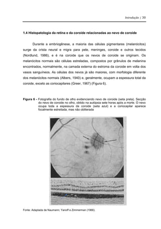 Introdução | 30
1.4 Histopatologia da retina e da coroide relacionadas ao nevo de coroide
Durante a embriogênese, a maioria das células pigmentares (melanócitos)
surge da crista neural e migra para pele, meninges, coroide e outros tecidos
(Nordlund, 1986), e é na coroide que os nevos de coroide se originam. Os
melanócitos normais são células estreladas, compostos por grânulos de melanina
encontrados, normalmente, na camada externa do estroma da coroide em volta dos
vasos sanguíneos. As células dos nevos já são maiores, com morfologia diferente
dos melanócitos normais (Albers, 1940) e, geralmente, ocupam a espessura total da
coroide, exceto as coriocapilares (Greer, 1967) (Figura 6).
Figura 6 - Fotografia do fundo de olho evidenciando nevo de coroide (seta preta). Secção
do nevo de coroide no olho, obtido na autópsia sete horas após a morte. O nevo
ocupa toda a espessura da coroide (seta azul) e a coriocapilar aparece
focalmente estreitada, mas não obliterada
Fonte: Adaptada de Naumann; Yanoff e Zimmerman (1966).
 