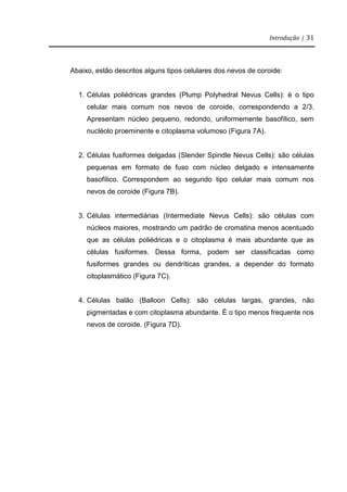 Introdução | 31
Abaixo, estão descritos alguns tipos celulares dos nevos de coroide:
1. Células poliédricas grandes (Plump Polyhedral Nevus Cells): é o tipo
celular mais comum nos nevos de coroide, correspondendo a 2/3.
Apresentam núcleo pequeno, redondo, uniformemente basofílico, sem
nucléolo proeminente e citoplasma volumoso (Figura 7A).
2. Células fusiformes delgadas (Slender Spindle Nevus Cells): são células
pequenas em formato de fuso com núcleo delgado e intensamente
basofílico. Correspondem ao segundo tipo celular mais comum nos
nevos de coroide (Figura 7B).
3. Células intermediárias (Intermediate Nevus Cells): são células com
núcleos maiores, mostrando um padrão de cromatina menos acentuado
que as células poliédricas e o citoplasma é mais abundante que as
células fusiformes. Dessa forma, podem ser classificadas como
fusiformes grandes ou dendríticas grandes, a depender do formato
citoplasmático (Figura 7C).
4. Células balão (Balloon Cells): são células largas, grandes, não
pigmentadas e com citoplasma abundante. É o tipo menos frequente nos
nevos de coroide. (Figura 7D).
 